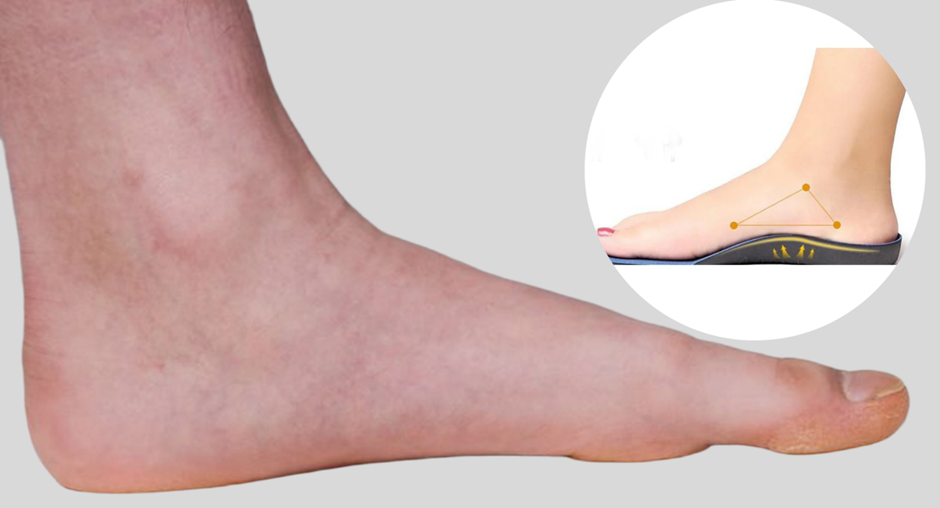 Best Arch Support Inserts for Flat Feet