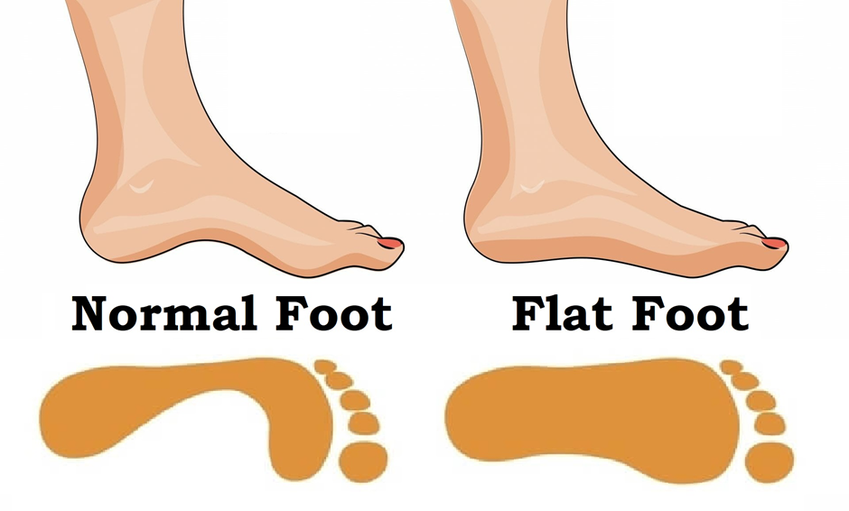 Flat Feet vs. Normal Feet