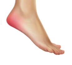 Does Medicare Cover Orthotics For Plantar Fasciitis