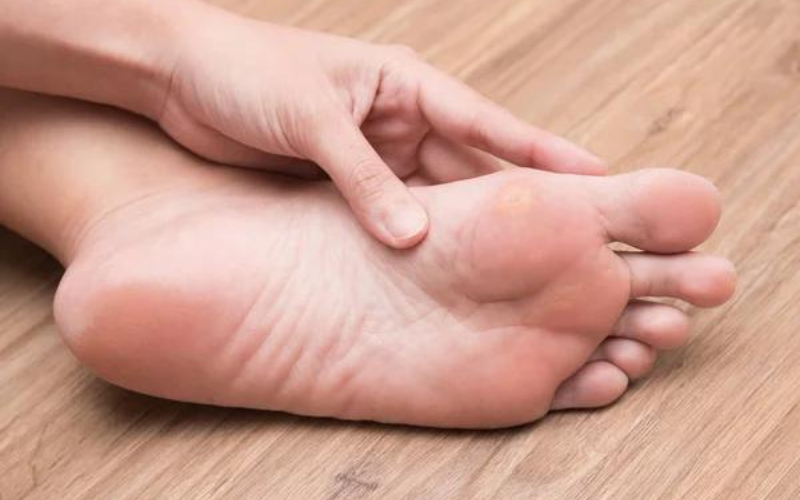 Best Insoles for Calluses: 2025 Ultimate Guide