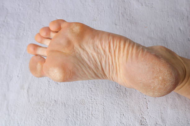 Best Insoles for Corns: The Ultimate 2025 Guide