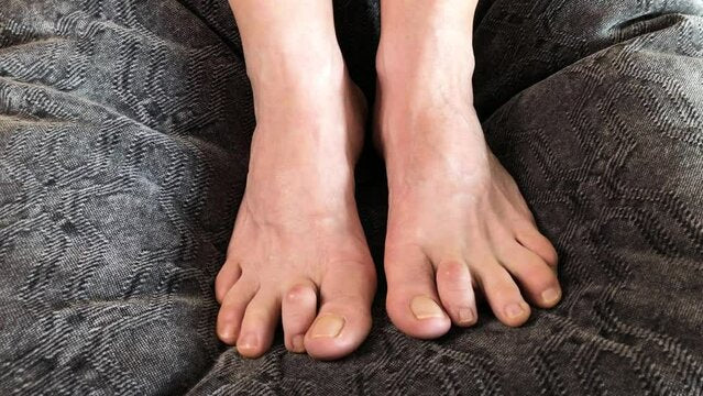 Best insoles for Hammer Toes: The ultimate guide